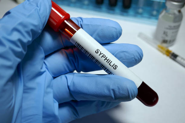 Kasusnya Melonjak, Ini Penyebab dan Cara Cegah Sifilis